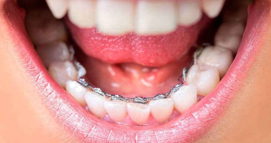 Ventajas ortodoncia lingual