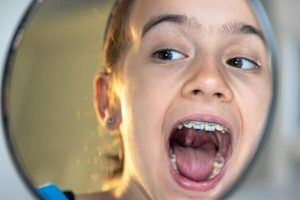 ortodoncia en niños a partir de que edad